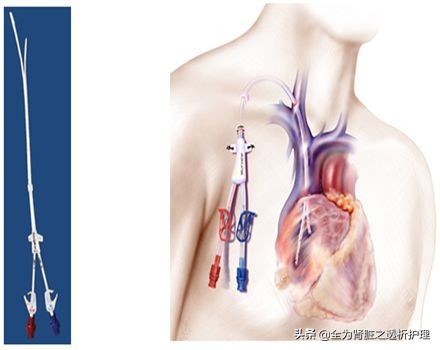 血透室中心静脉导管护理ppt,血透用瘘后能洗澡吗
