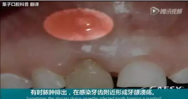 上牙龈上火突出一个鼓包,牙龈肿胀鼓包上火了吗