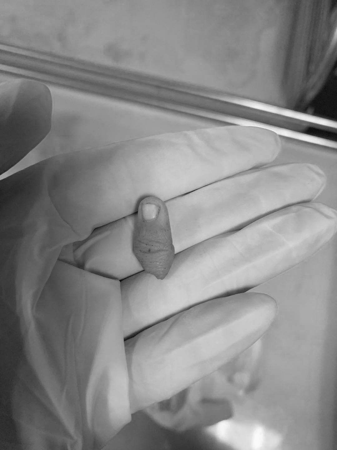 断指再植接动脉显微镜视频,穿针引线手术