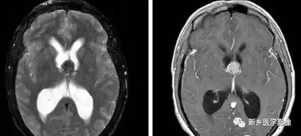 脑室为什么会扩张,脑室为什么会变小