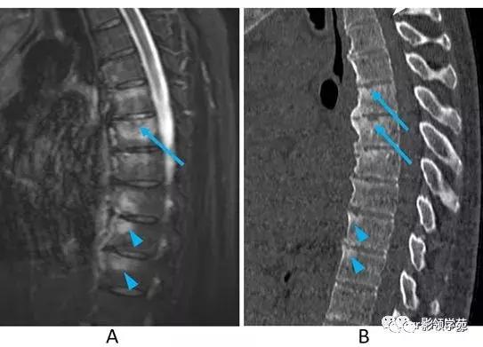 9种椎体和椎旁信号增高的非肿瘤性病变