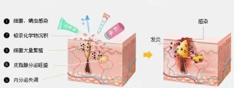 孩子长痘痘用什么中药好,小孩长痘了该怎么祛痘呢