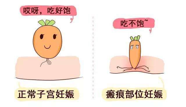 这种特殊的异位妊娠,你听过么?