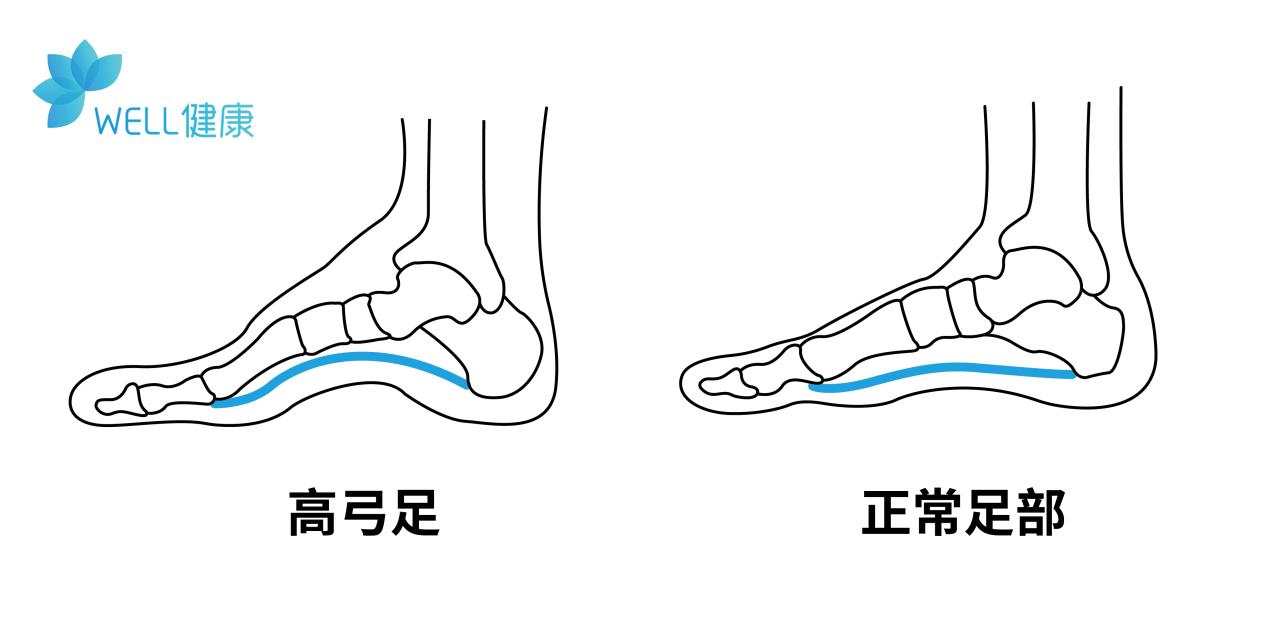 脚后跟痛的病因,脚后跟疼痛预示疾病发生