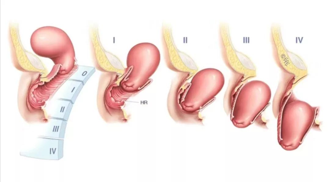 77岁老人子宫脱落的概率,难言之隐的病