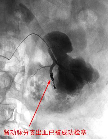 便血尿血怎么办,便血就医