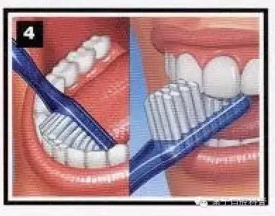 拉锯式刷牙可能造成牙齿缺损,暴力刷牙造成牙齿楔状缺损