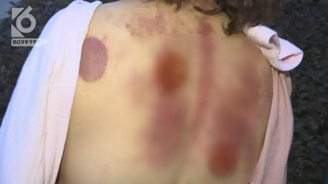 女性湿气太重拔火罐有用吗,拔火罐后有水泡是烫伤还是湿气