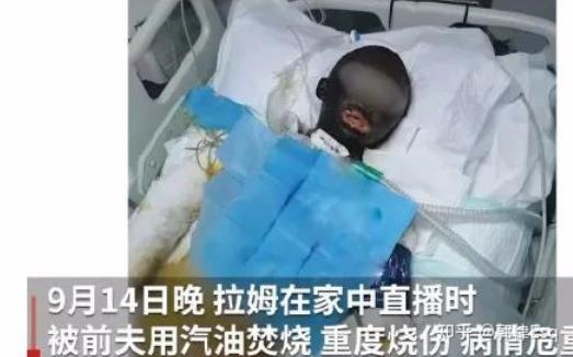 网红拉姆直播被烧的现场,网红拉姆遭前夫焚烧重度烧伤