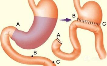 胆囊把胆汁输送到哪里,胆囊炎和胃病胆汁反流有区别吗