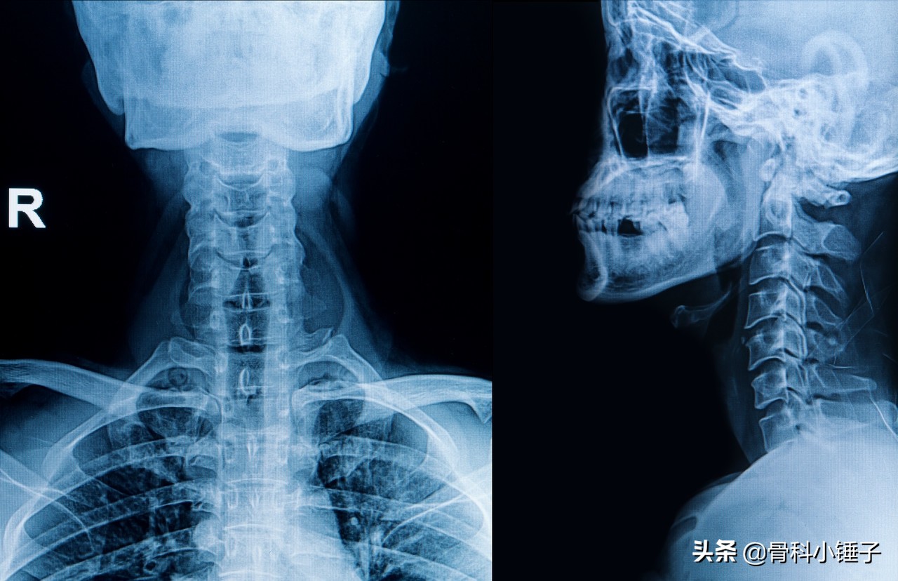 神经根型颈椎病微创手术效果,神经型颈椎病微创手术