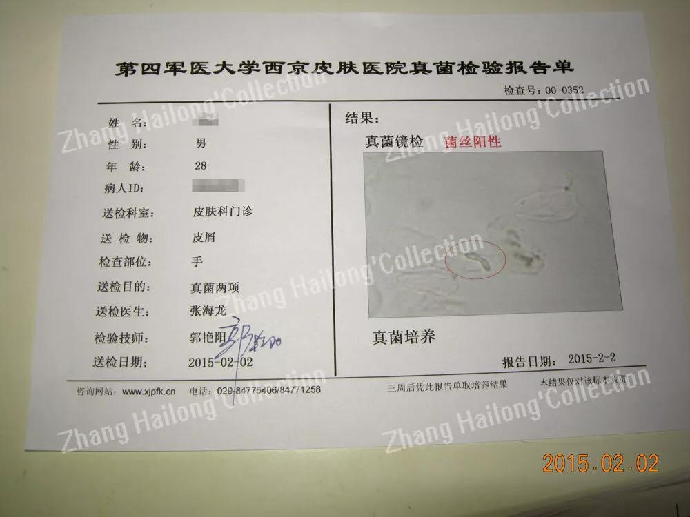 小狗脸上长癣怎么办,孩子脸上长癣是怎么回事啊