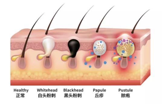 让无数姑娘无从下手的痘印，皮肤科医生有了解决新招