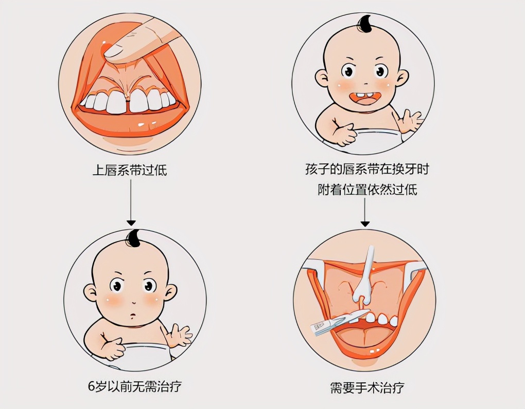 门牙中间为什么有缝隙,门牙中间有缝咋回事