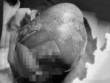 孩子头上有个包抹什么能消下去,孩子头上有包块是怎么回事