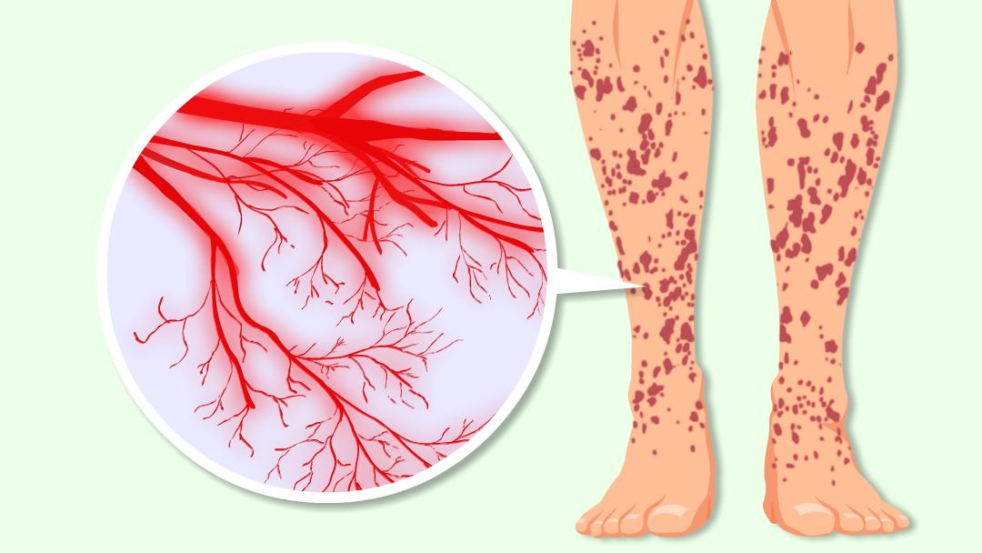 小孩腿上有紫癜发热了怎么办,婴儿腿上有紫癜但没有其他症状