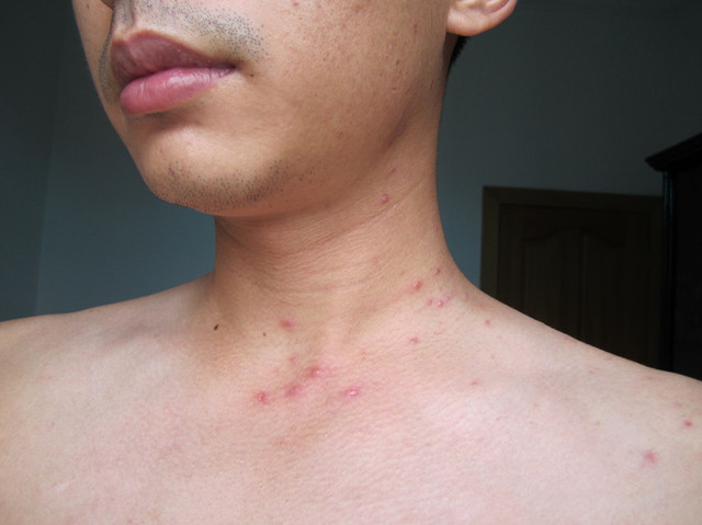 艾滋病的皮肤病会反复出现吗,艾滋病的早期表现别以为是皮肤病