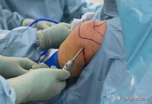 膝关节积液一招搞定就好了,膝关节有积液原因及解决方案