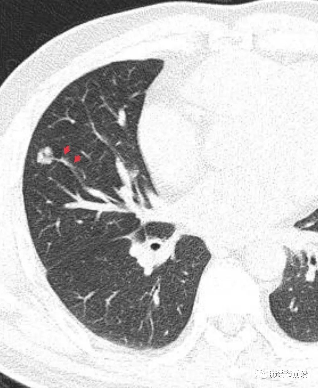 肺部ct肺结节读片教学视频,肺结节读片的专业术语