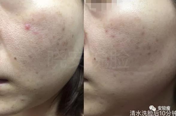 外油内干敏感痘肌怎么护肤,30岁油皮痘痘敏感肌怎么改善