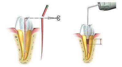 口腔科医生：什么是牙髓炎？牙髓炎主要有哪些症状？