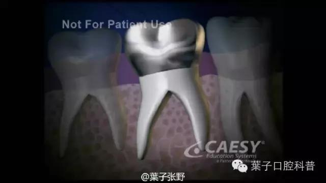 牙龈反复鼓包流脓是牙齿坏了吗,一上火牙龈就鼓包