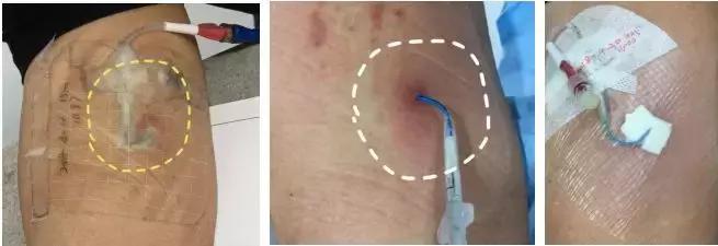 撕贴膜有气泡怎么办,贴膜有大水泡需要处理吗