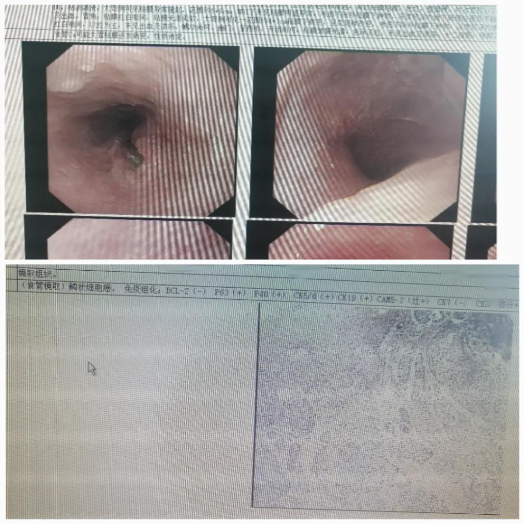 食管癌其实没那么可怕,食管癌最不可能发生的并发症