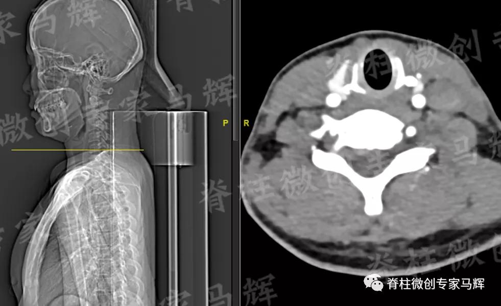 脊椎压迫神经做了微创术后腿麻疼,神经根损伤疼痛治疗