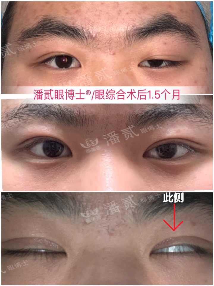 上睑下垂手术是不是永远闭不上眼,做了上睑下垂手术后怎么护理眼睛