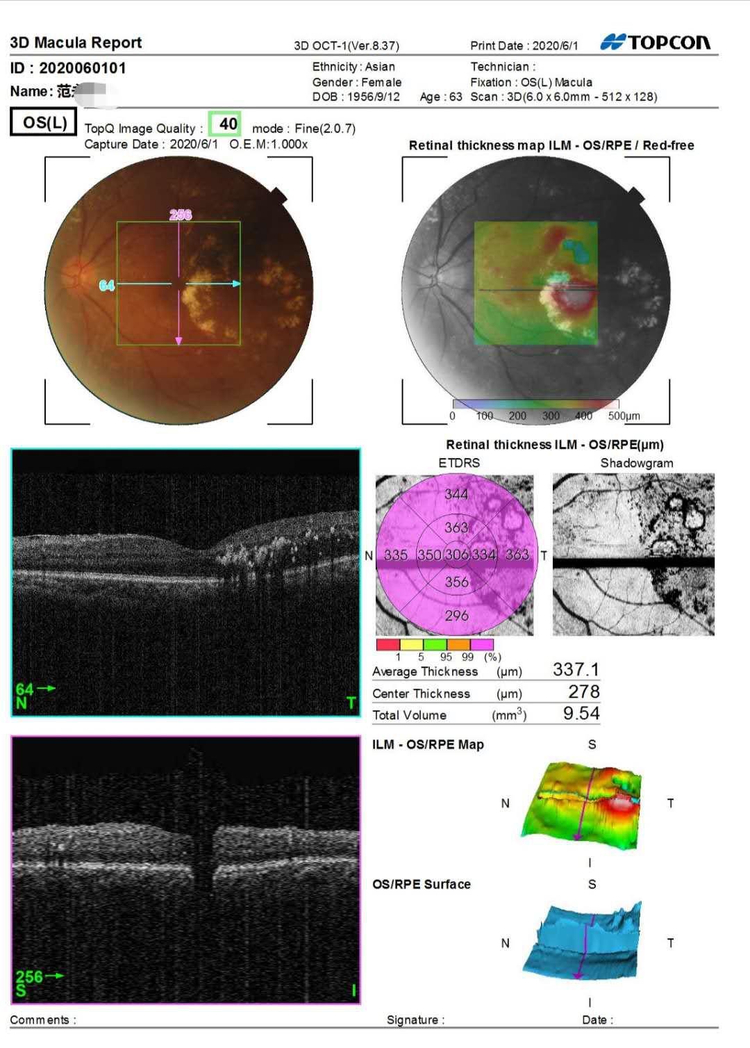 眼科先天性眼底病变,眼底病变医院