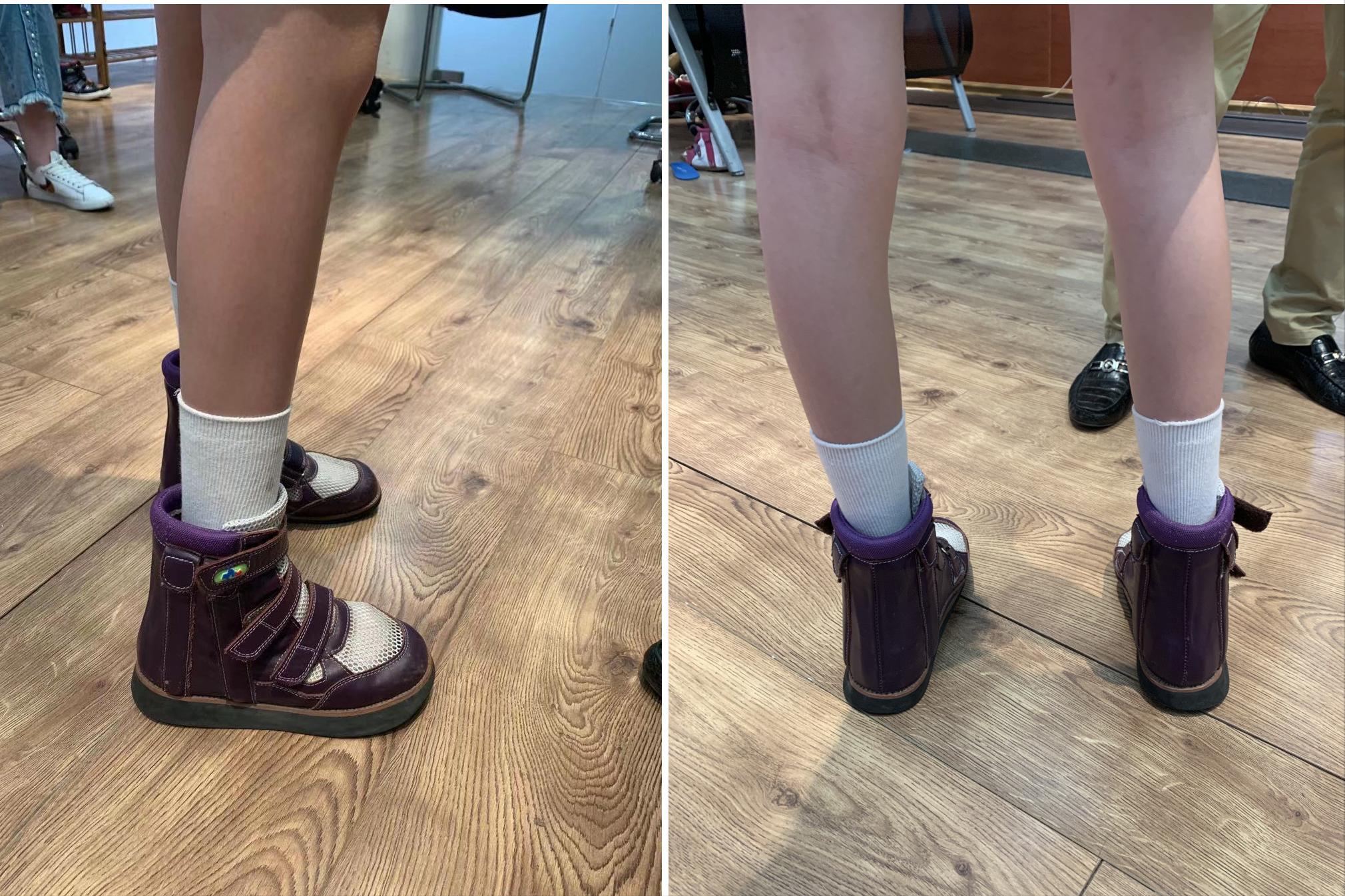 足内翻矫正鞋真的可以矫正吗,马蹄内翻足矫正鞋要穿多久