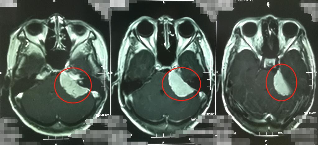 什么是脑膜瘤，为什么被发现时往往很大了？