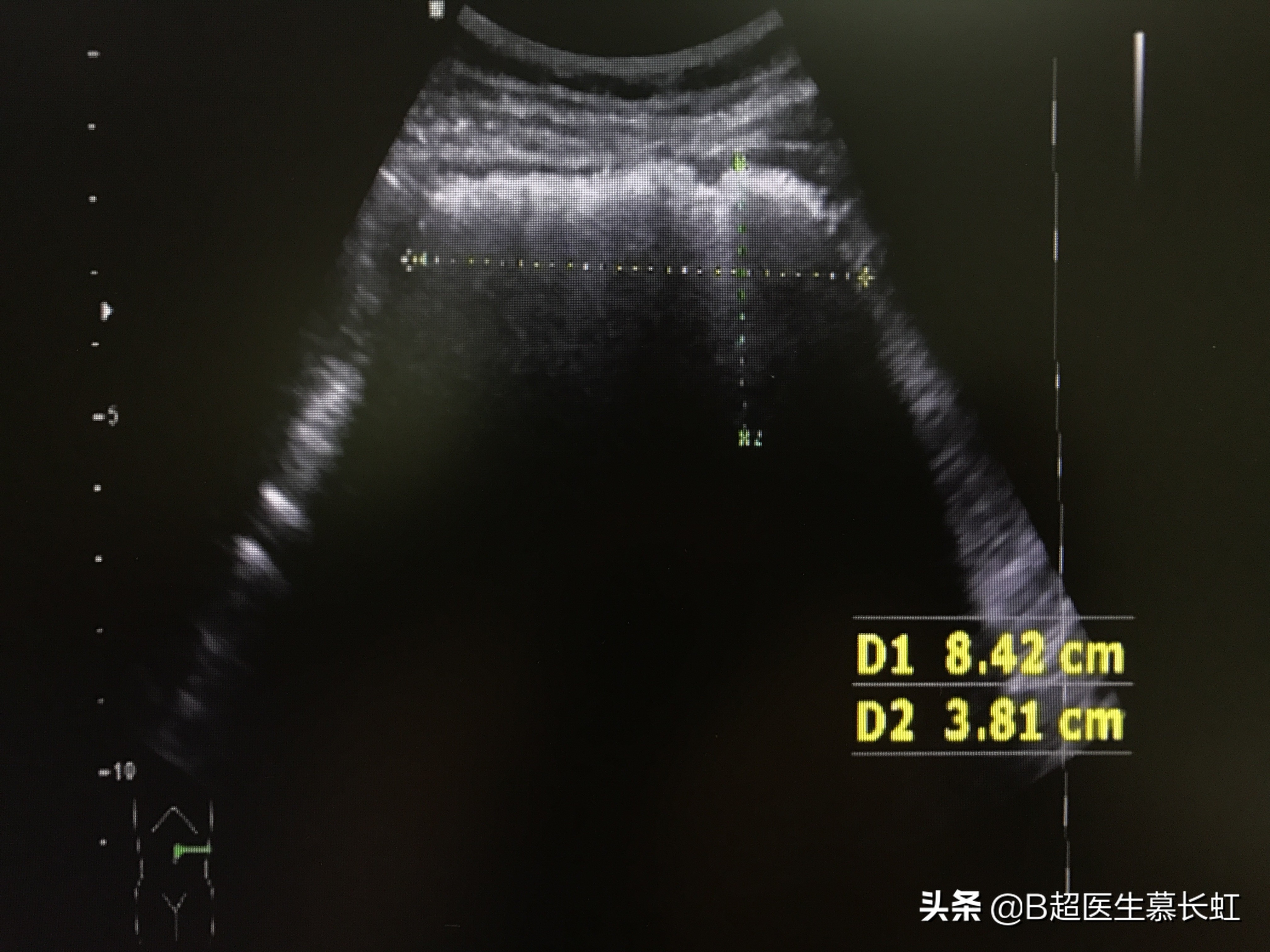 结石山楂可以吃吗,山楂容易长结石吗