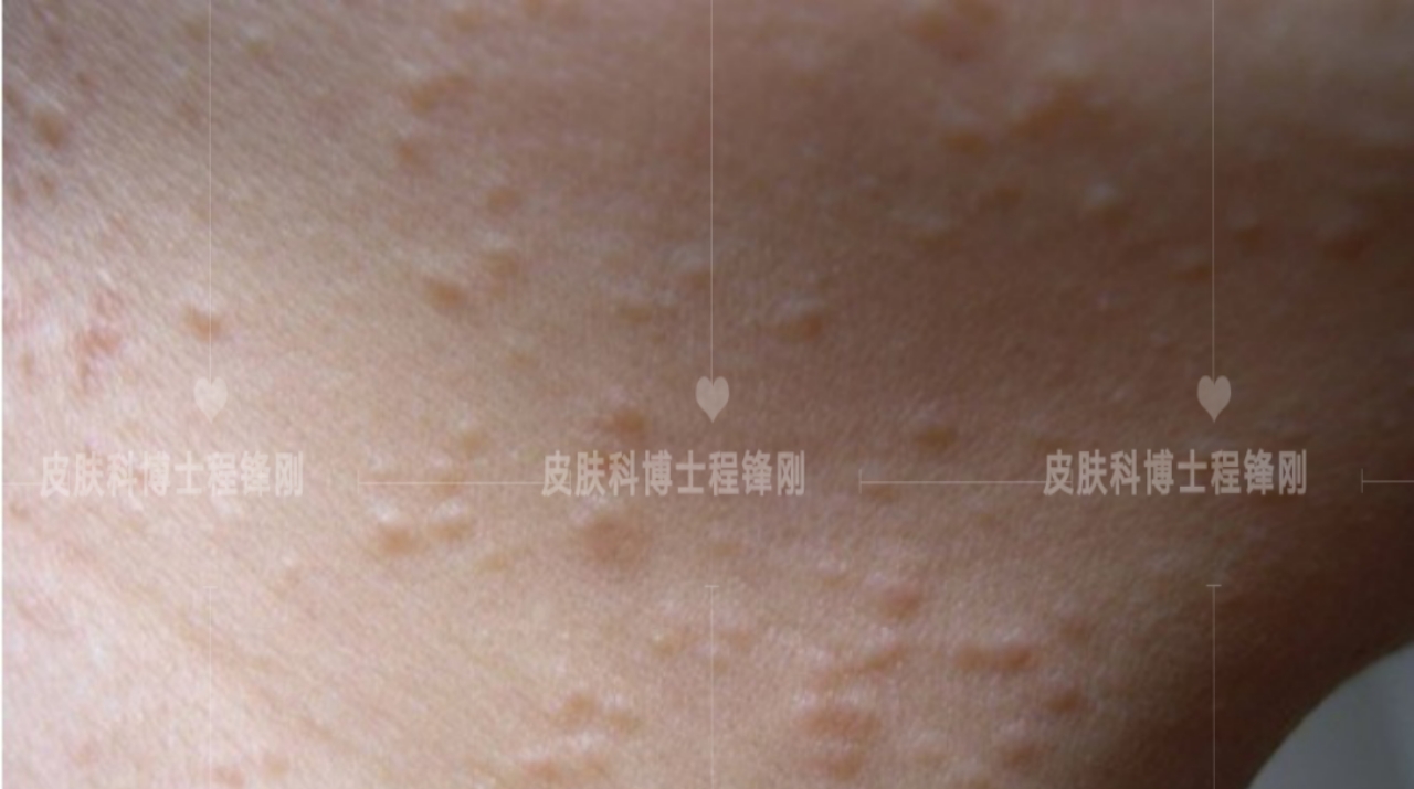 患有扁平疣要怎么根治,有扁平疣一定要及时去除吗