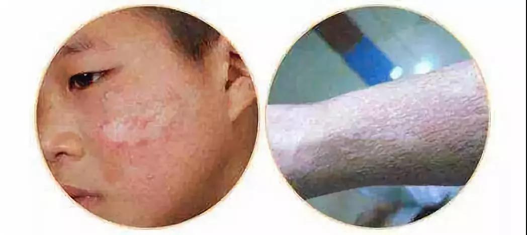 身上有疤痕用什么药可以去除,瘢痕去除偏方