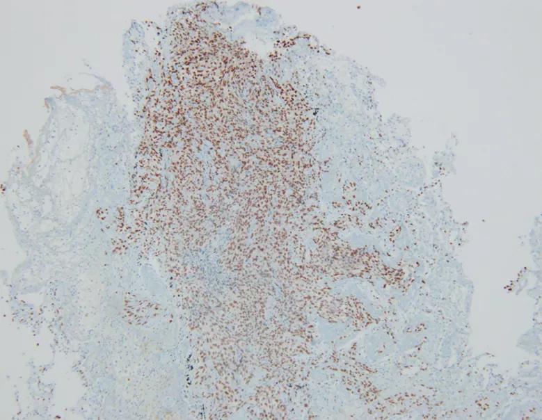 弥漫性肺泡出血能治好吗,弥漫性肺泡出血能活多久