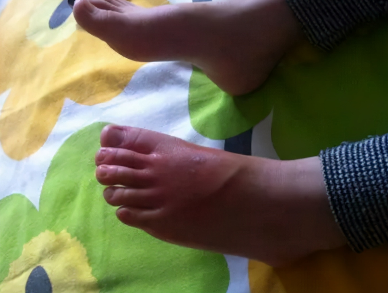 小孩被烫伤家人急救措施,孩子被烫伤家长应该怎么处理