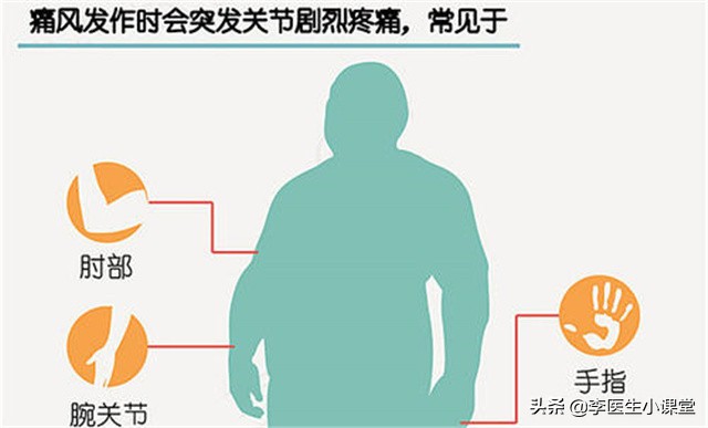 痛风发作怎么办一招教你缓解痛风,痛风发作疼痛难耐三招快速缓解