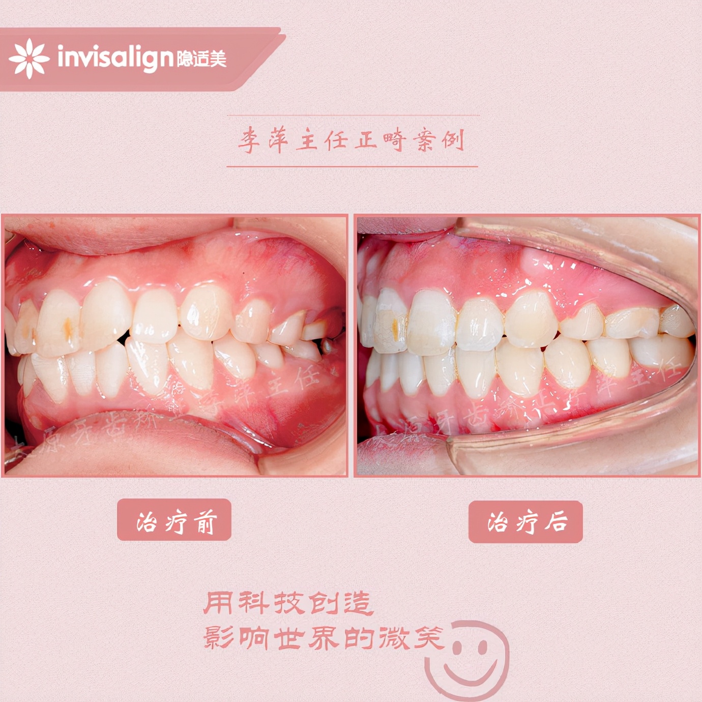 太原牙齿矫正拔牙拔六颗有危害吗,太原牙齿开合矫正