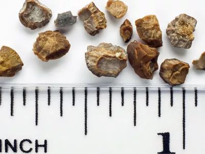 不手术怎么去除胆囊结石,不想做胆结石手术