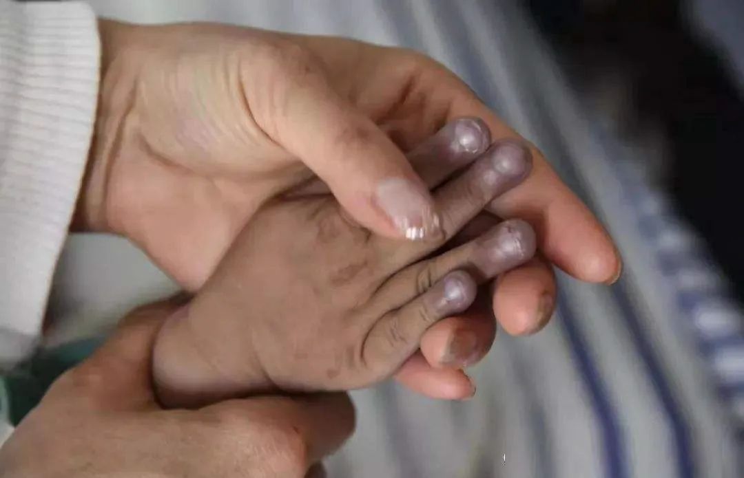 先天性心脏病儿童指南,先天性心脏病的宝宝治愈最佳时间