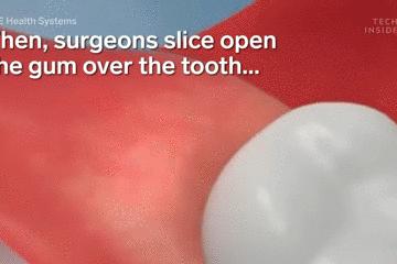 手术的时候医生对你做了什么,手术时切了一片肺叶