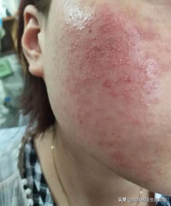 玫瑰痤疮别名酒糟鼻怎么治疗,酒糟鼻玫瑰痤疮的发病机制