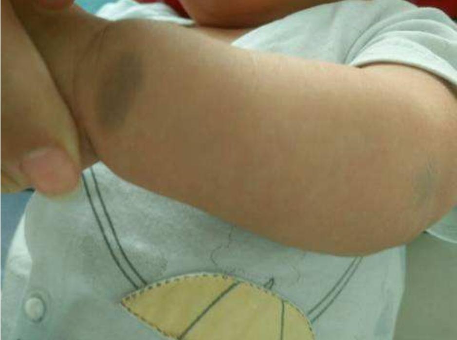 婴儿身上像有淤青一样的怎么回事,小婴儿身上有淤青是什么原因