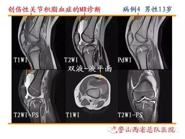 膝关节炎髌上囊积液自己看得出吗,髌上囊有积液膝盖会走路无力吗