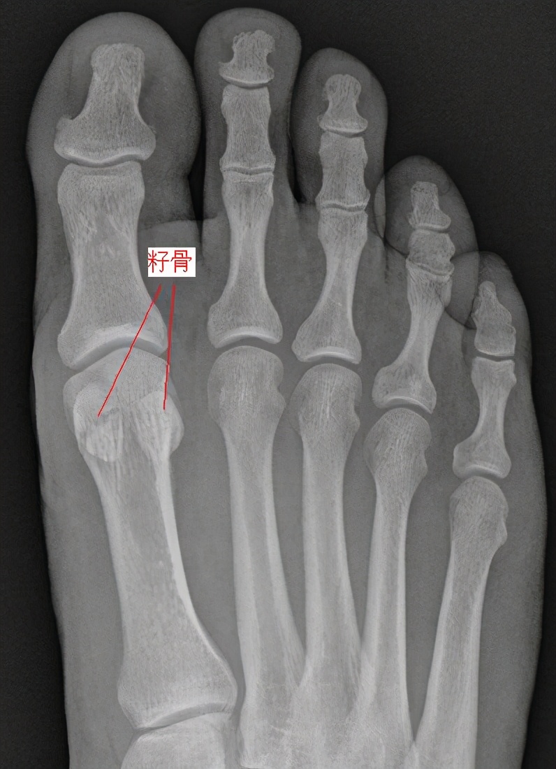 草皮趾什么症状,草地趾怎么康复