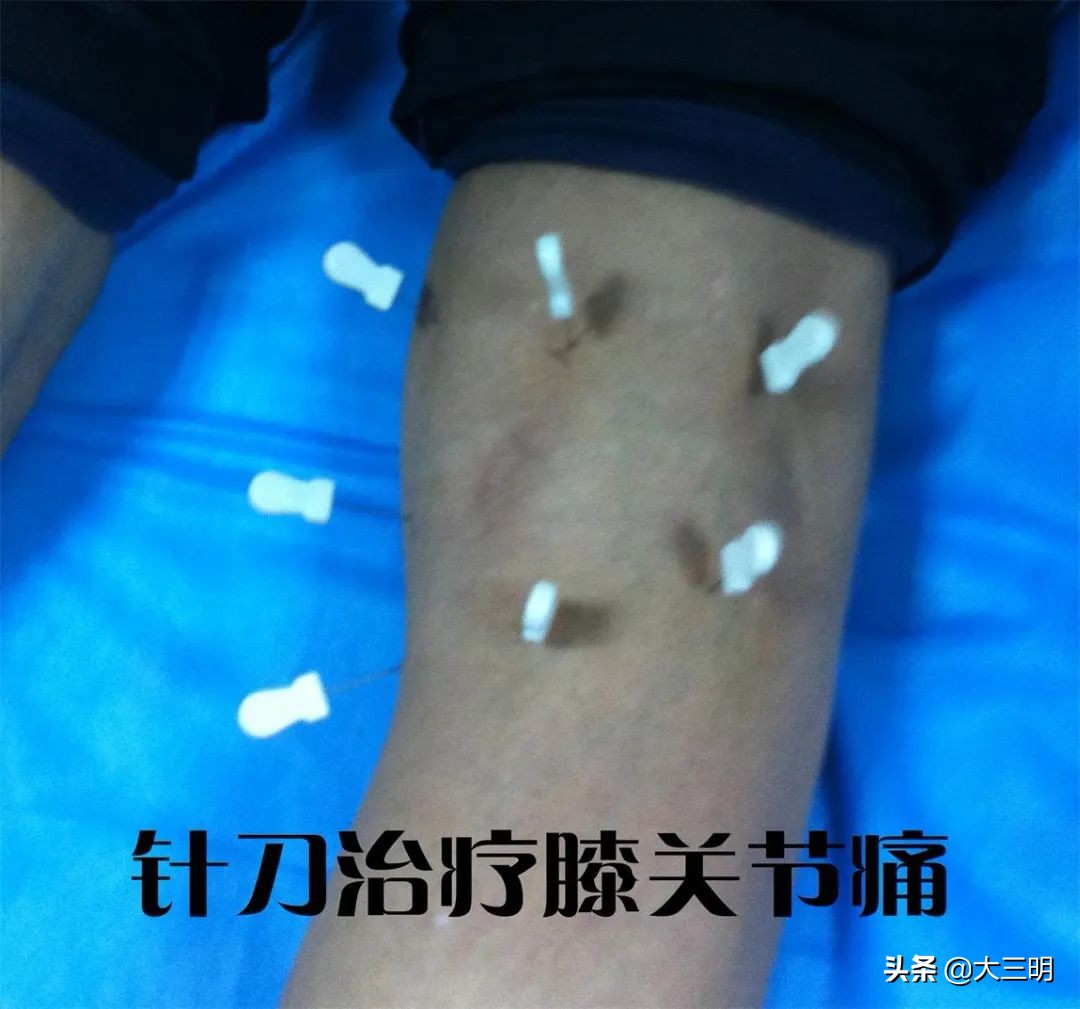 顽固性网球肘的敲打治疗,网球肘针刀效果怎么样