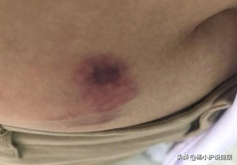 肚皮针应该怎么打,皮肤才没有淤癍?