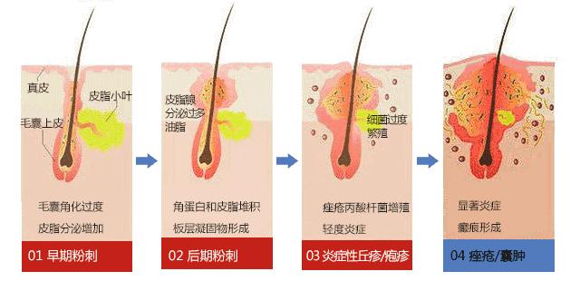 脸上痘坑痘印用什么方法修复,满脸痘坑疤痕怎么去除